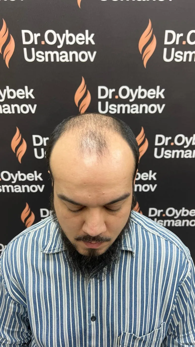 Пациент 1 до пересадки волос