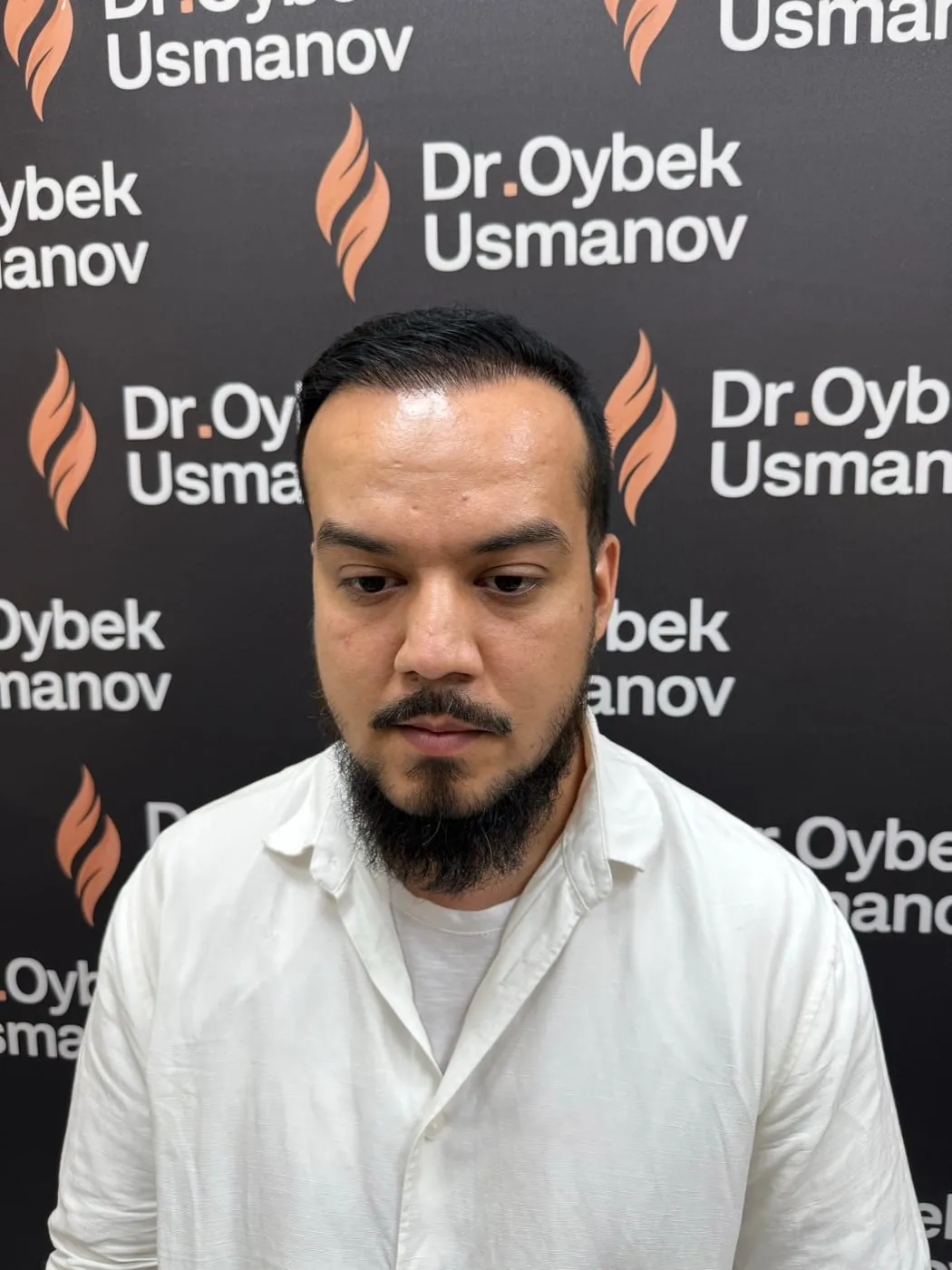 Тот же пациент 1 после пересадки волос