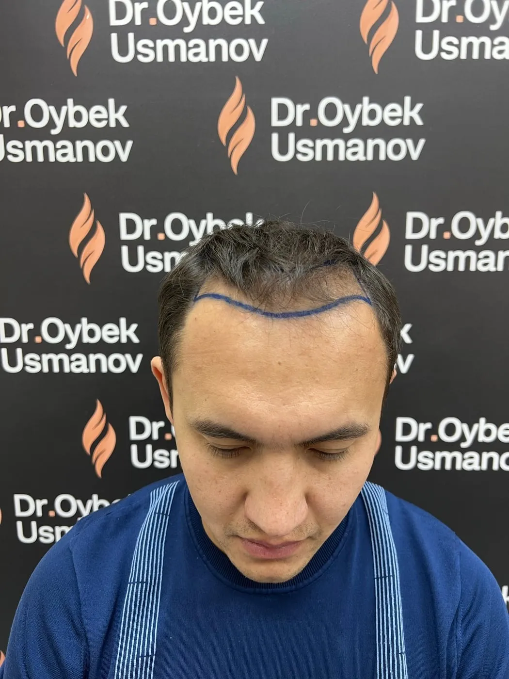 Пациент 2 до пересадки волос