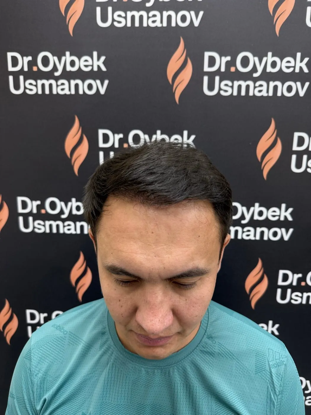 Тот же пациент 2 после пересадки волос
