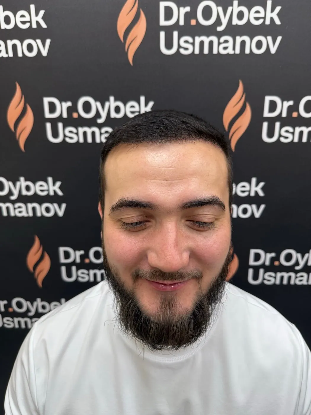 Тот же пациент 3 после пересадки волос