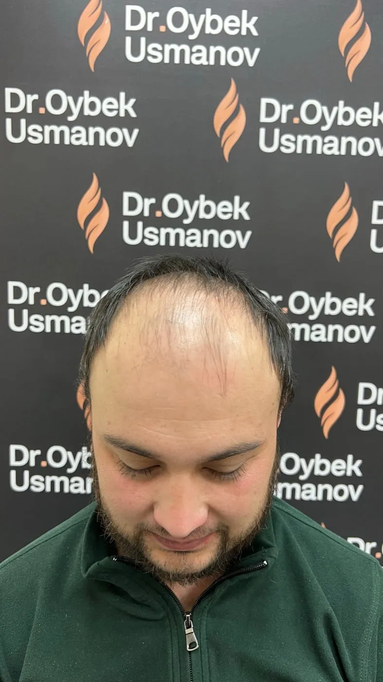 Пациент 4 до пересадки волос