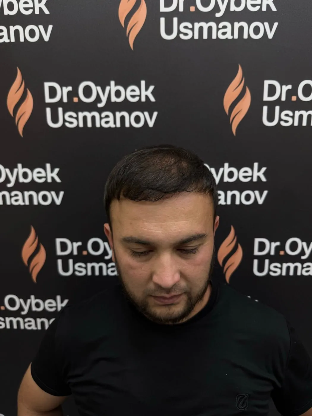 Тот же пациент 4 после пересадки волос