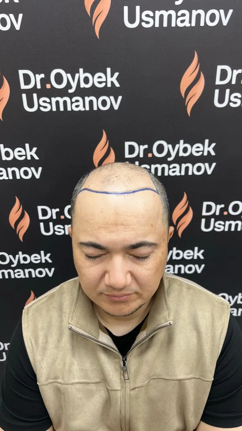 Пациент 5 до пересадки волос
