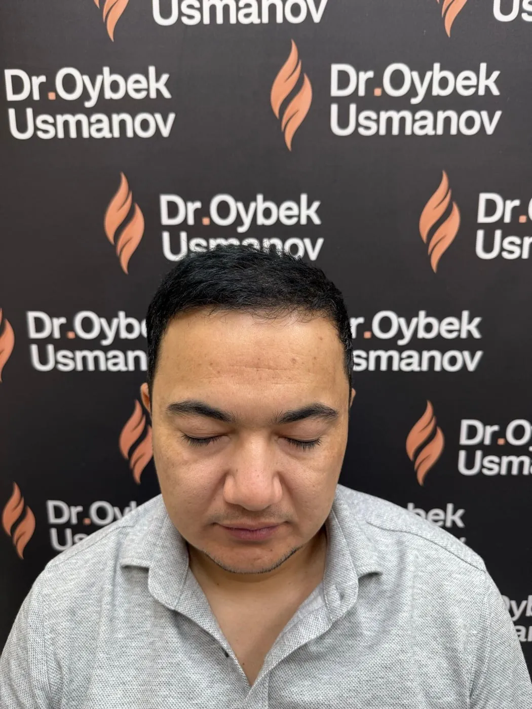 Тот же пациент 5 после пересадки волос