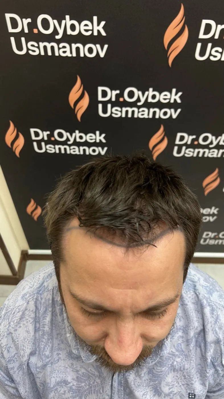 Пациент 6 до пересадки волос