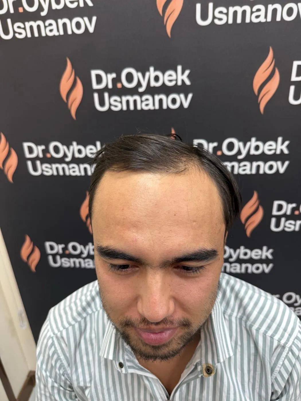 Пациент 7 до пересадки волос