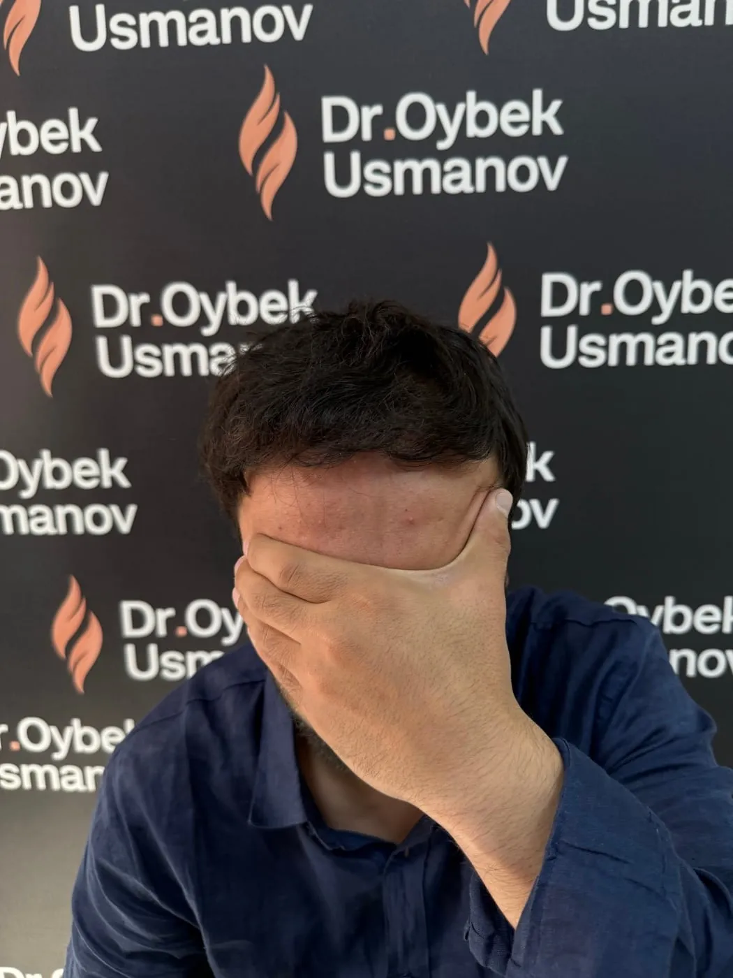 Тот же пациент 7 после пересадки волос
