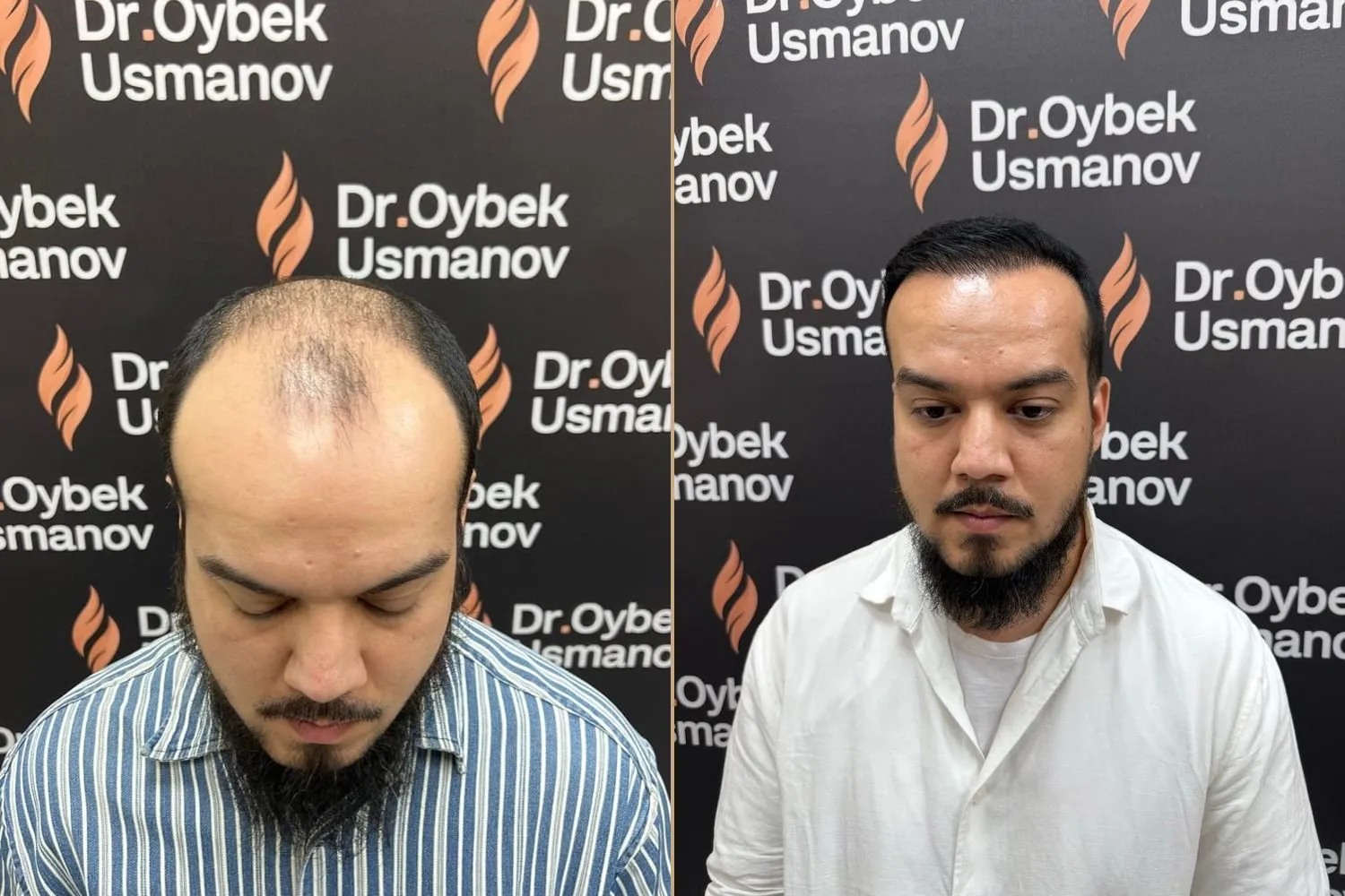 Пациент клиники до пересадки и через 9 месяцев после FUE