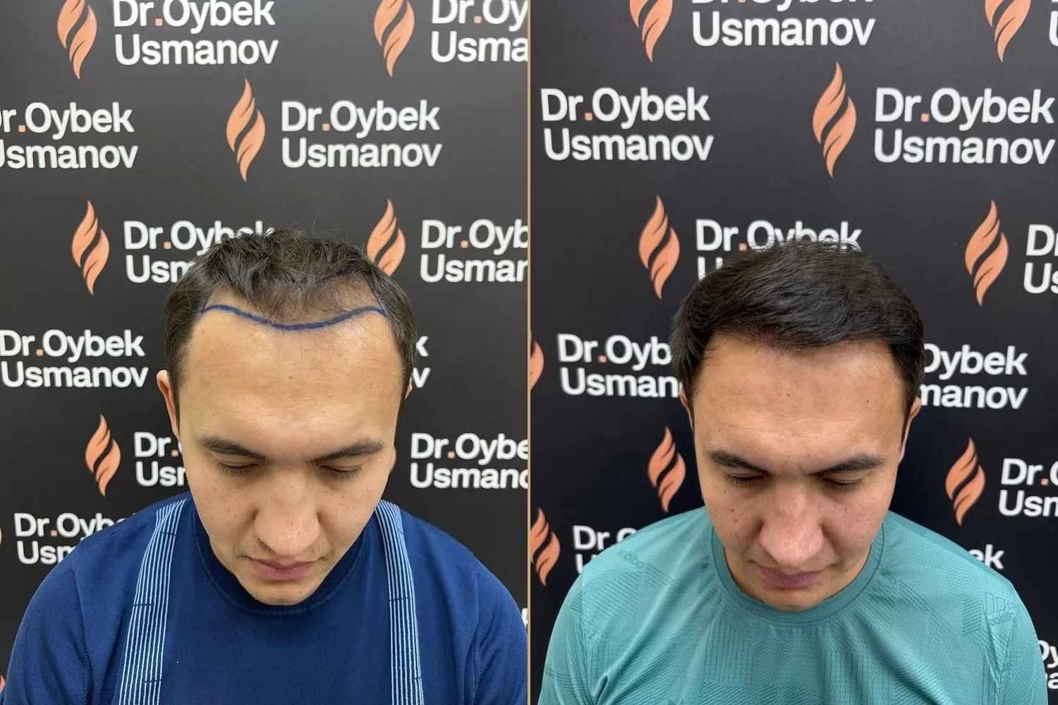 Пациент клиники до пересадки и через 12 месяцев после FUE