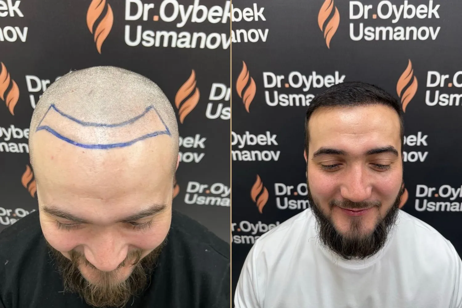 Bemor koʻchirishdan oldin va FUE dan olti oy keyin