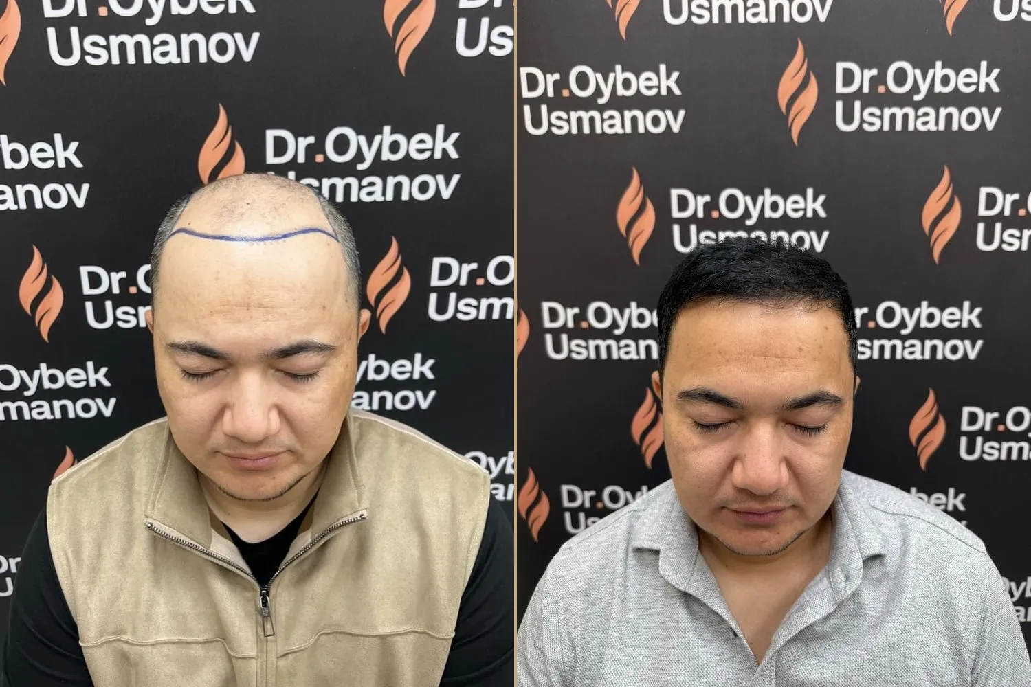 Пациент клиники до пересадки и через 12 месяцев после FUE