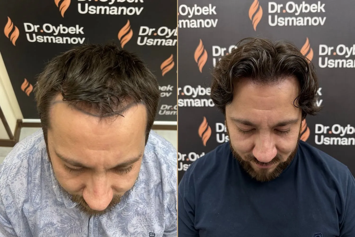 Пациент клиники до пересадки и через 12 месяцев после FUE