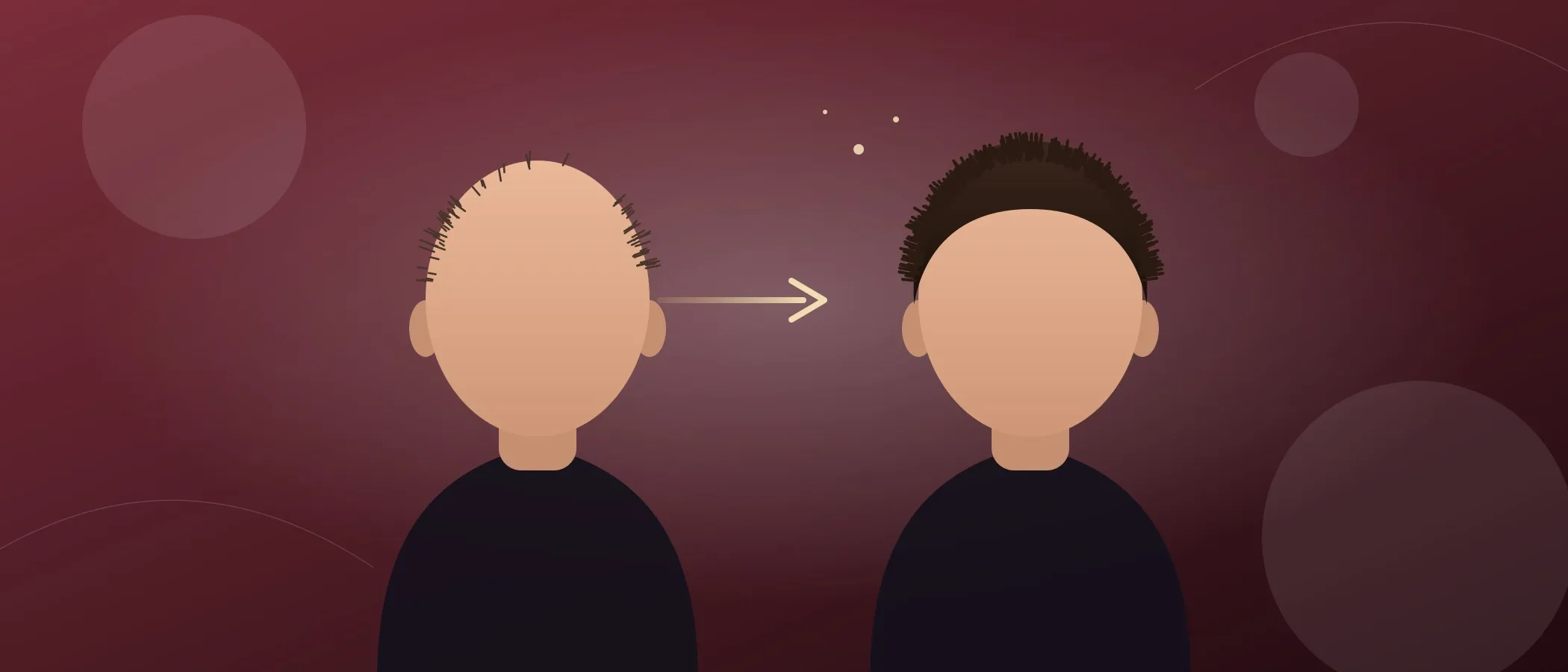 Smoking and hair transplants: does it affect graft survival and when to quit